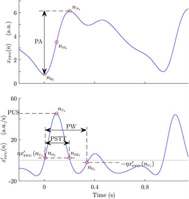 Baroreflex Sensitivity Measured by Pulse Photoplethysmography